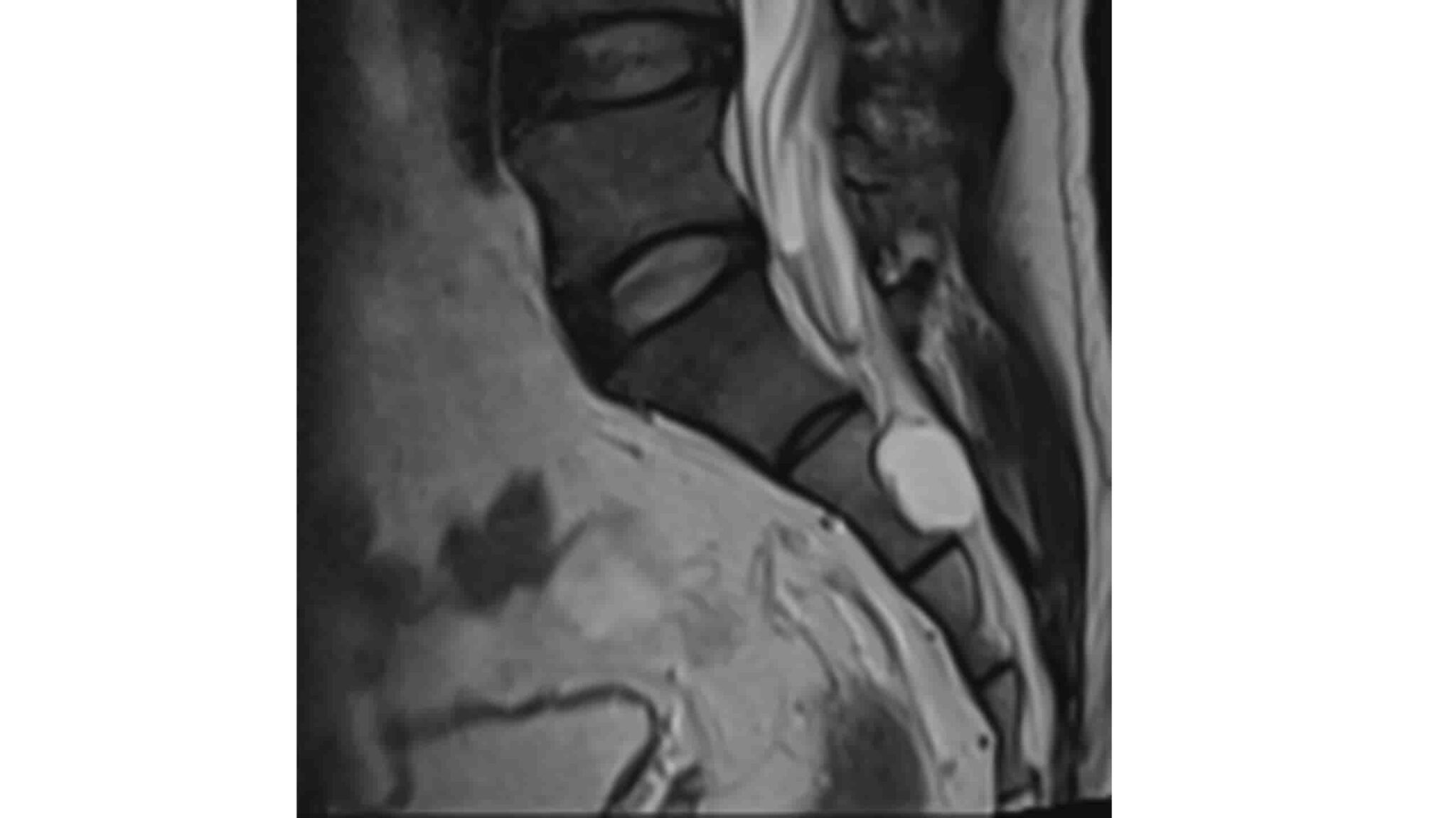 Manage Tarlov Cysts with Medical Marijuana | Rethink-Rx