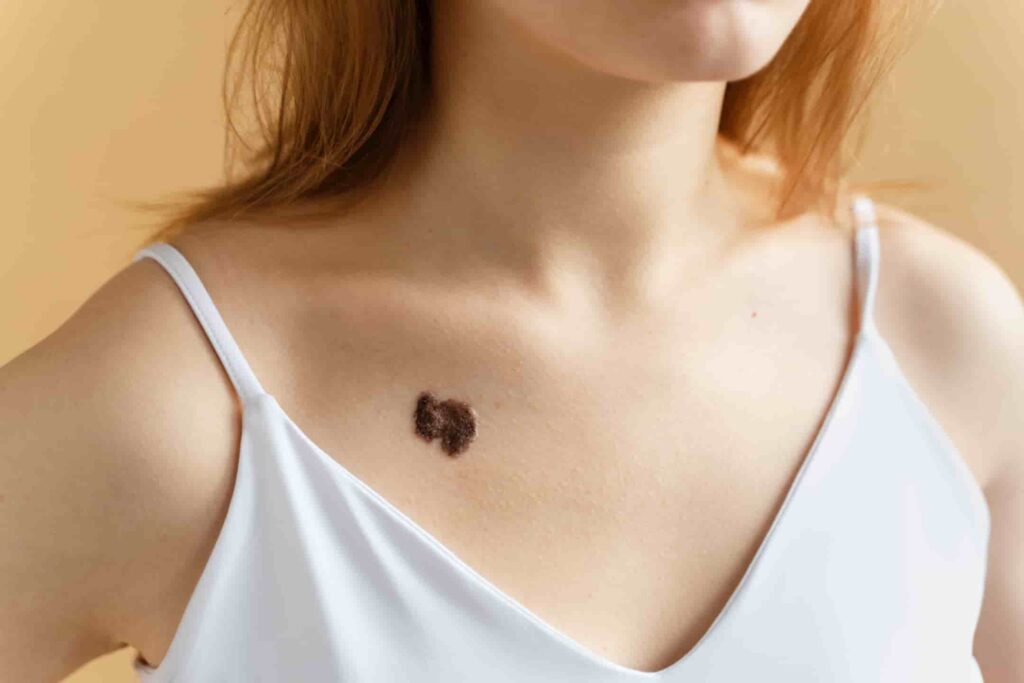 patients-with-skin-cancer-may-benefit-from-medical-cannabis